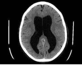Imagem de TC: hidrocefalia 